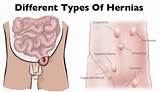 Hernia Surgery Recovery Symptoms Photos