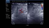 Medical Renal Disease Ultrasound Pictures