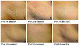 Laser Brown Spot Removal Cost Photos