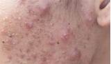 Acne Treatment Oral Medication Pictures