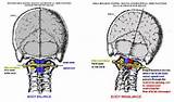 Neck Vertebrae Out Of Alignment Treatment Pictures