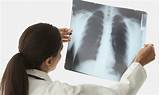 Pictures of Walking Pneumonia Treatment Mayo Clinic