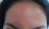 Images of Eczema On Forehead Treatment