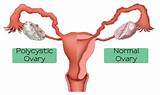 Pcos Syndrome Natural Treatment