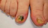 Images of Foot Doctor For Nail Fungus