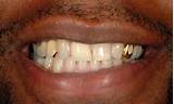 Gold Teeth Dentist Photos