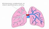 Pulmonary Artery Dilatation Treatment