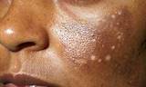 Images of Laser Treatment For Skin Pigmentation Side Effects