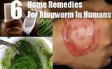 Kill Ringworm Home Remedies Images