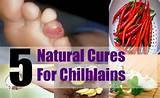 Chilblains Home Remedies Photos