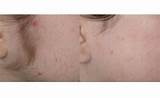 Laser Hair Removal On Head Side Effects Images