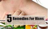 Chronic Hives Home Remedies Pictures