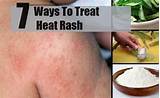Home Remedies For Prickly Heat Rash On Face