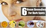 Photos of Home Remedies For Dark Spots