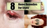 Photos of 6 Home Remedies For Styes