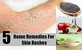 Skin Rash Treatment Home Remedies