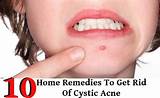 Pictures of Home Remedies Cystic Acne