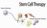 How Much Is Stem Cell Therapy Photos