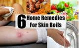 Old Home Remedies For Boils Images