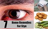 Home Remedies For Styes On Upper Eyelid Photos