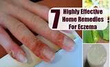Eczema Hands Home Remedies