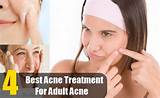 What Is The Best Treatment For Hormonal Acne Photos