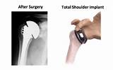 Shoulder Replacement Recovery Process