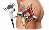 Partial Hip Replacement Recovery Time Elderly
