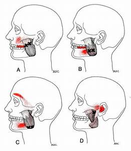 Masseter The Trigger Point Referred Guide