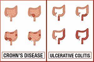Crohn S Disease Vs Ulcerative Colitis Differences In Symptoms Causes