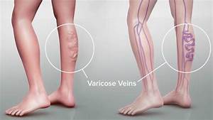 Varicose Vein Are Your Compression Itchy