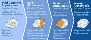 What Are The Four Stages Of Alzheimers Dementia Talk Club