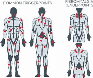 Back Trigger Points Chart Self Trigger Point Guide