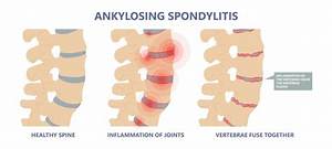 Ankylosing Spondylitis Wins Benefits Cannon Disability Law