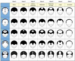 The Definitive Guide To Norwood Hair Scale 2022 Clinmedica