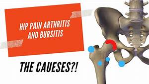 Hip Arthritis Bursitis Aw Boon Wei