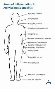 Areas Of Inflammation In Ankylosing Spondylitis Diagram Psoriasis