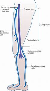 Varicose Veins In Primary Care The Bmj