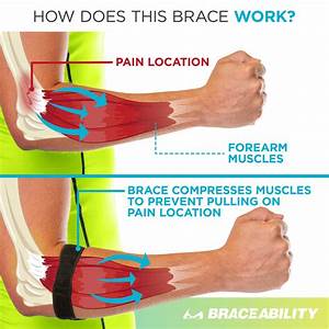 Epicondylitis Brace Elbow For Medial Lateral Epicondyle 