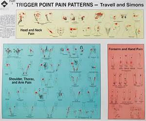 Myofascial Trigger Points Definition Signs Symptoms Diagnosis Therapy