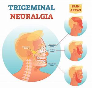 U1253 Therapeutic Failure In Trigeminal Neuralgia