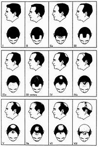  Pattern Baldness The Hamilton Baldness Scale As Modified By