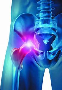 Troubleshooting Hip Part Ii Arthritis Advisor