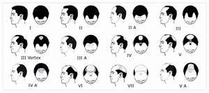 Norwood Scale Assess Your Hair Loss With Pics Celebrity Examples