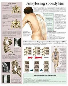 Ankylosing Spondylitis E Chart Quick Reference Guide By Hc Healthcomm