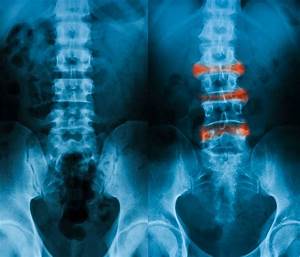 Ankylosing Spondylitis Ct Scan