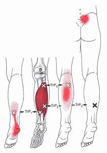 Soleus The Trigger Point Referred Guide
