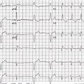 Pacemaker EKG