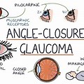 Angle-Closure Glaucoma