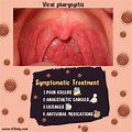 Viral Pharyngitis